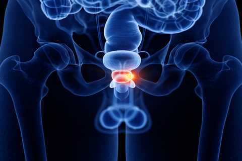 Myths and Truths about Prostate Cancer: What You Need to Know