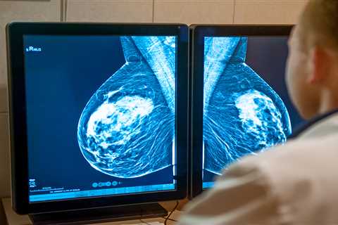 AI in NHS Clinics Detects Breast Cancer Cases Earlier and Faster