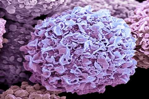 Why Dense Breasts Might Increase the Risk of Breast Cancer