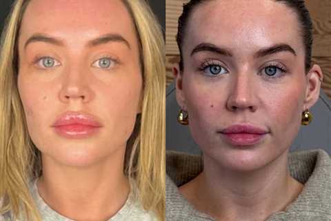 Love Island's Samantha Kenny reveals face transformation after reversing unnatural look