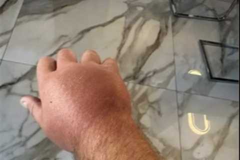 Gerwyn Price's Hand Looks Like a Balloon (And Not the Fun Kind)